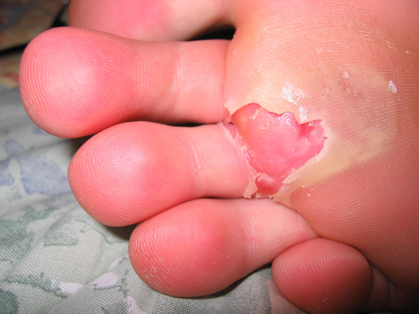 blister-foot-ocs-hike-hump